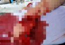 Jari tangan kiri korban YY (38) nyaris putus akibat tebasan parang MH (35).